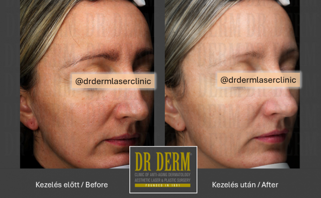 HALO hybrid laser_Dr Derm 7