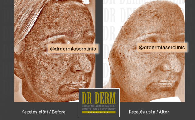 HALO hybrid laser_Dr Derm 8