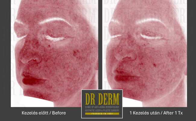 Potenza_Dr Derm Budapest 1