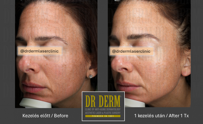 Potenza_Dr Derm Budapest 10