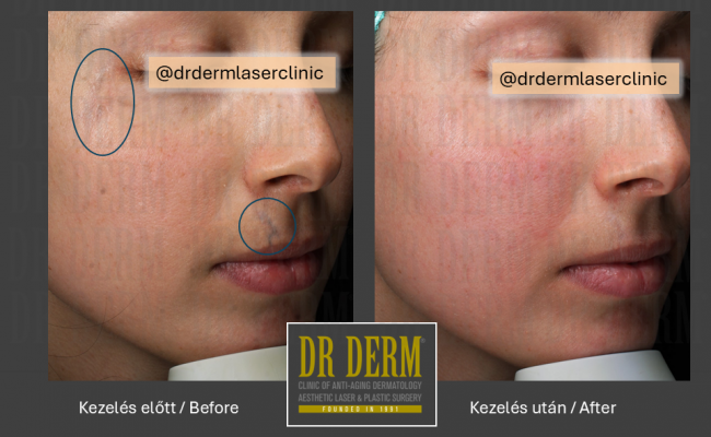 Potenza_Dr Derm Budapest 11