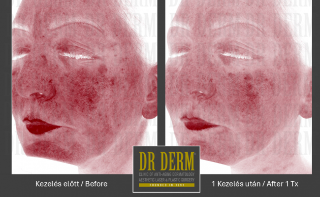 Potenza_Dr Derm Budapest 2