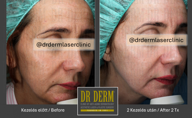 Potenza_Dr Derm Budapest 3
