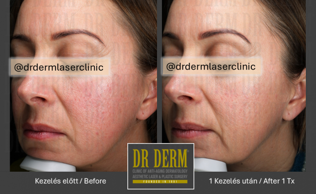 Potenza_Dr Derm Budapest 4