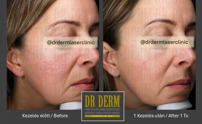 Potenza_Dr Derm Budapest 5