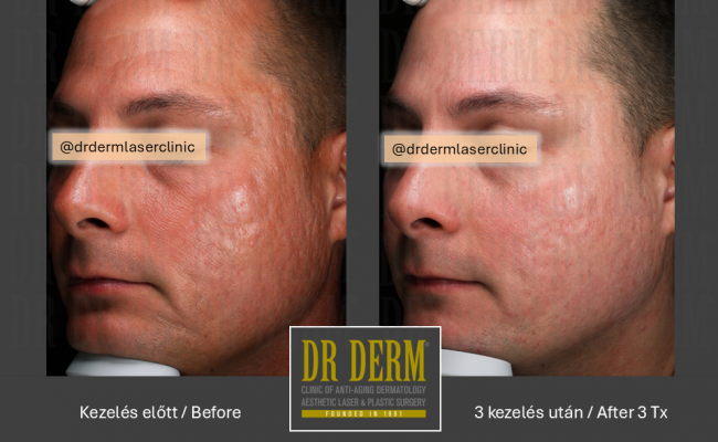 Potenza_Dr Derm Budapest 6