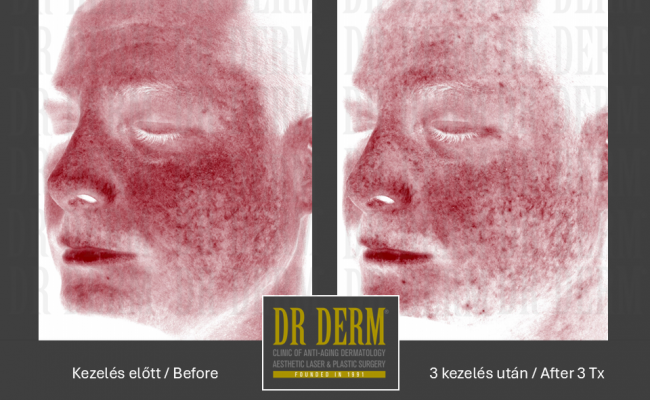 Potenza_Dr Derm Budapest 7