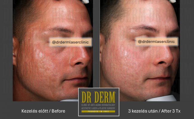 Potenza_Dr Derm Budapest 8