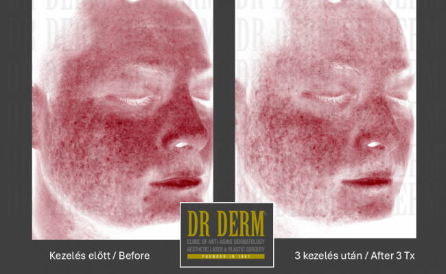 Potenza_Dr Derm Budapest 9