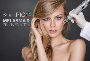Melasma halványítás SmartPICO lézerrel