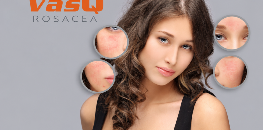 Rosacea, tűzfolt festéklézer kezelése